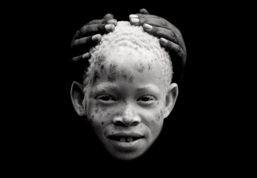 Chica albina, Tanzania. Eric Lafforgue